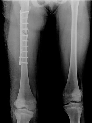 Ảnh 4 của Femoral Fracture